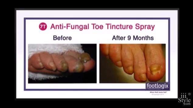 Footlogix 3+ 7+ 7T 7NT Before and After Pedicure Amazing Results! 